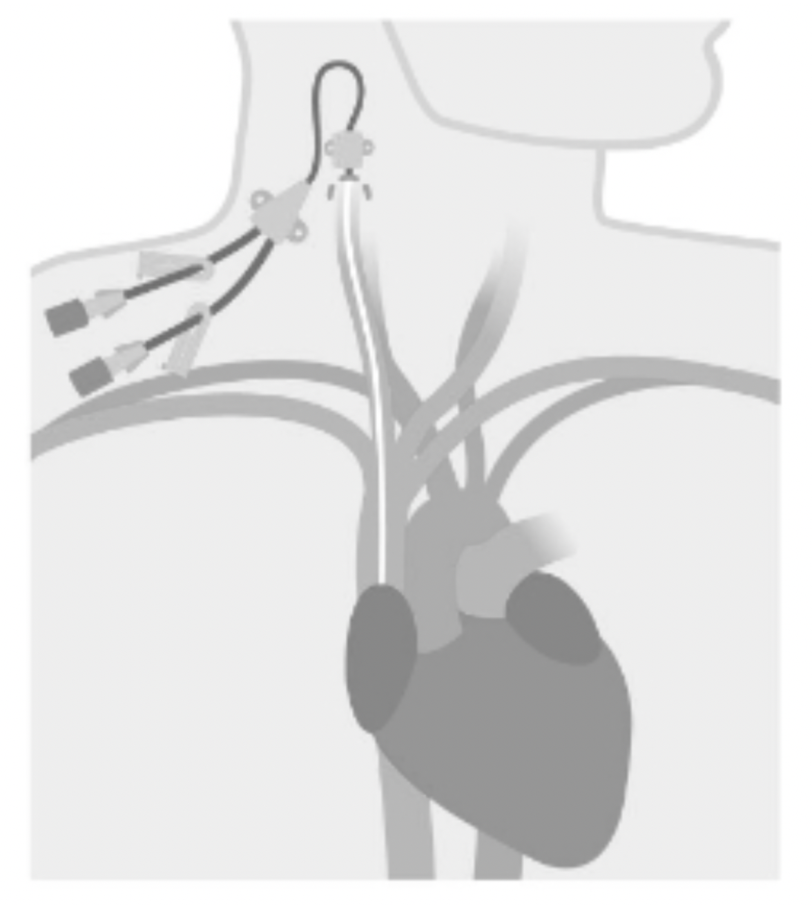 Tunneled Catheter Placement